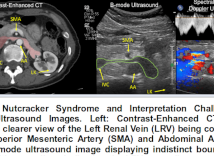 Venal Vein Compression